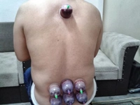 Boyun Fıtığına Sülük Tedavisi