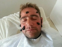 Sinüzit Sülük Tedavisi