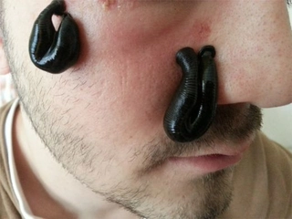 Sivilcelere Sülük Tedavisi